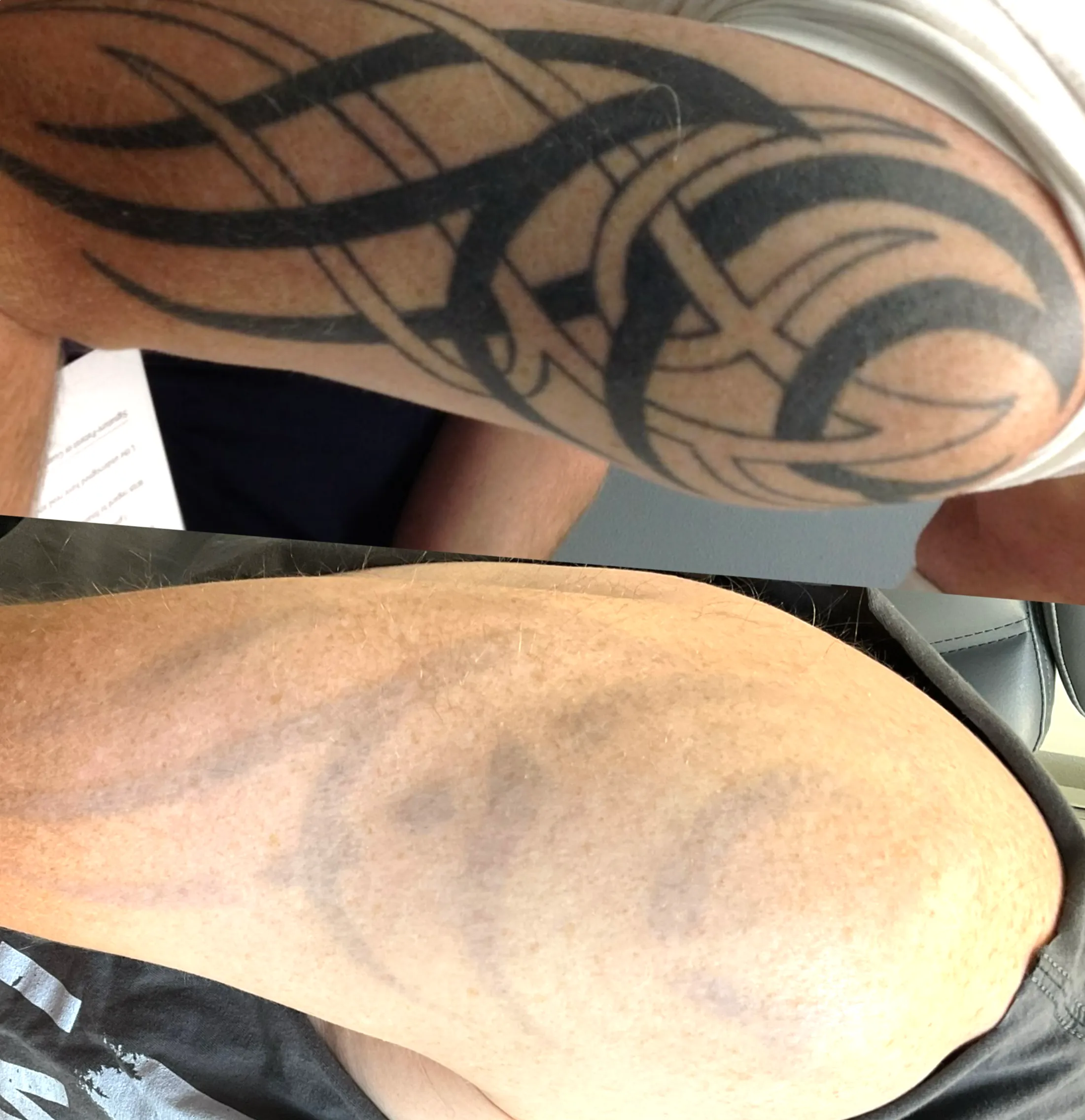 tattoo removal aftercare tips