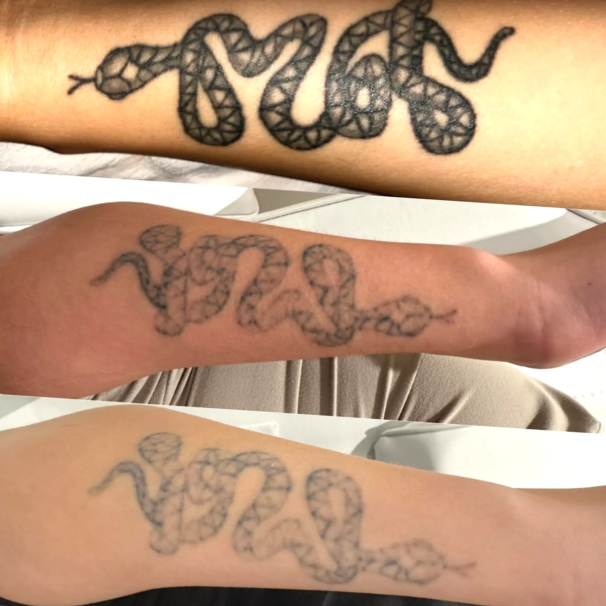 lymphatic drainage tattoo removal
