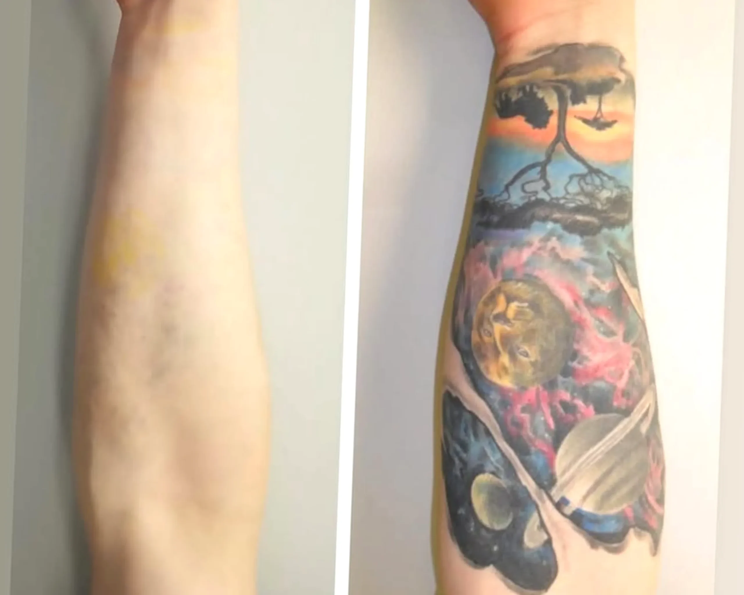 how laser tattoo removal works