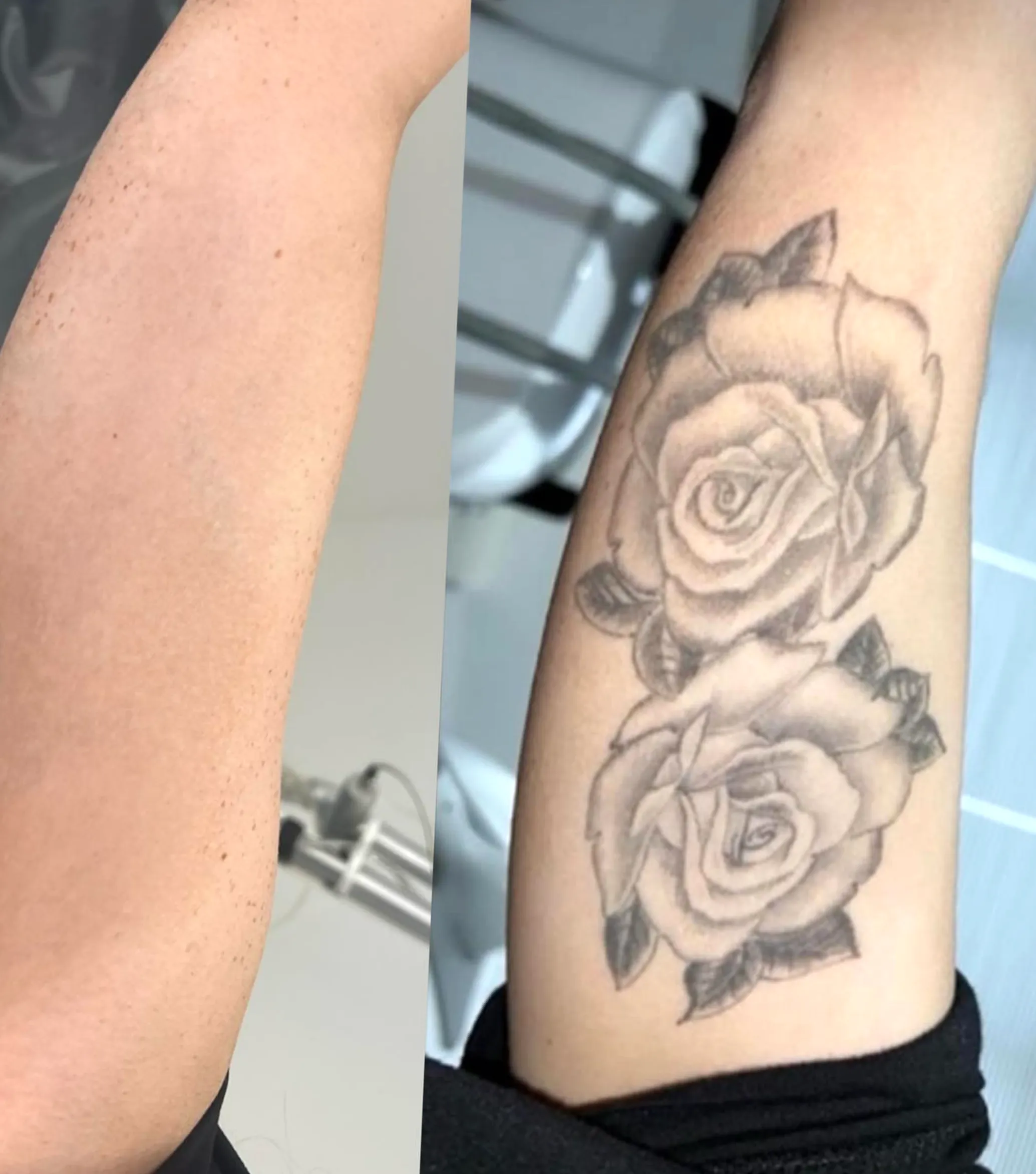 tattoo removal healing process
