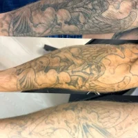 what happens after tattoo removal