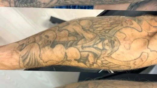 what happens after tattoo removal