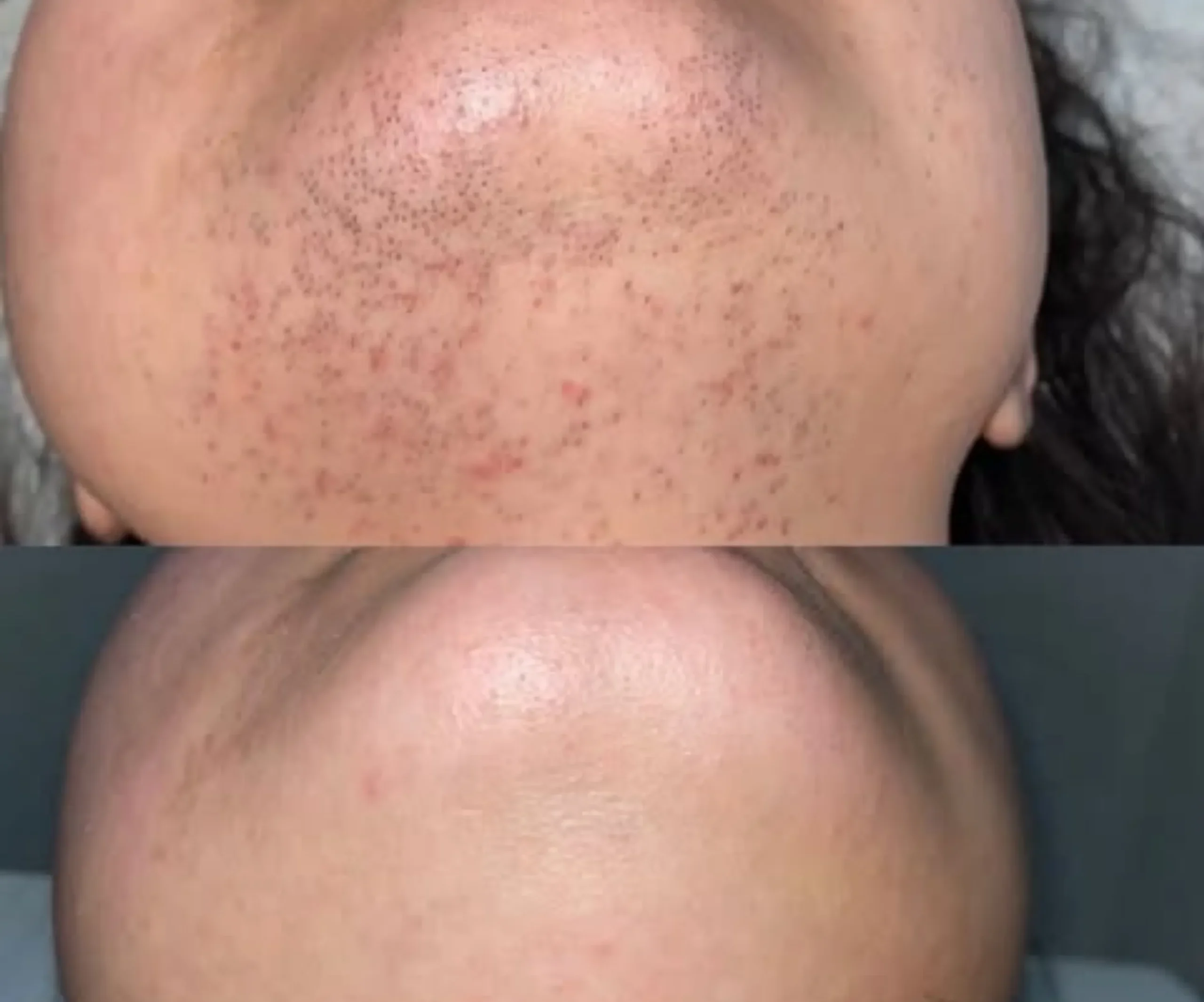 laser hair removal certification Australia