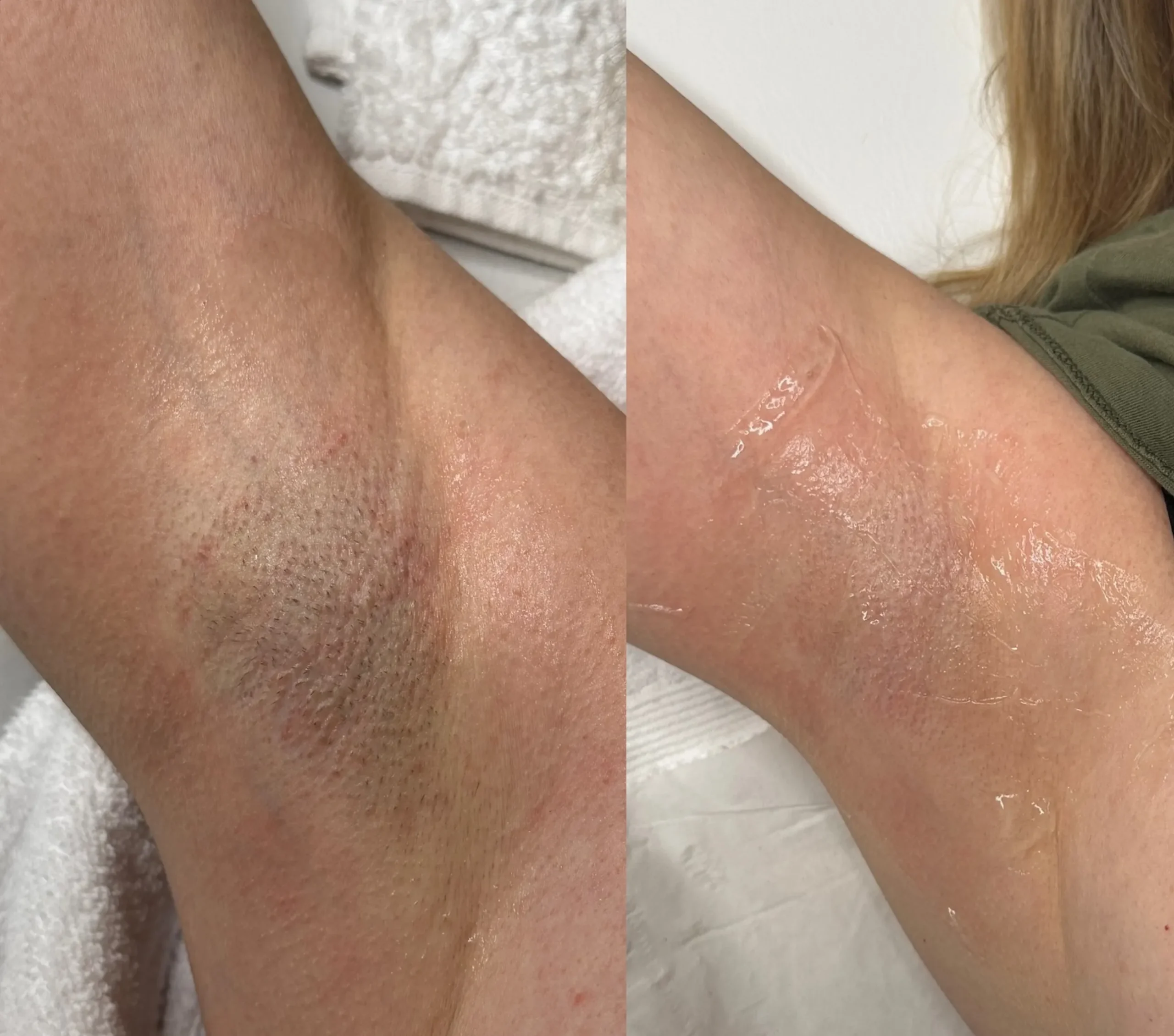 laser hair removal course Australia